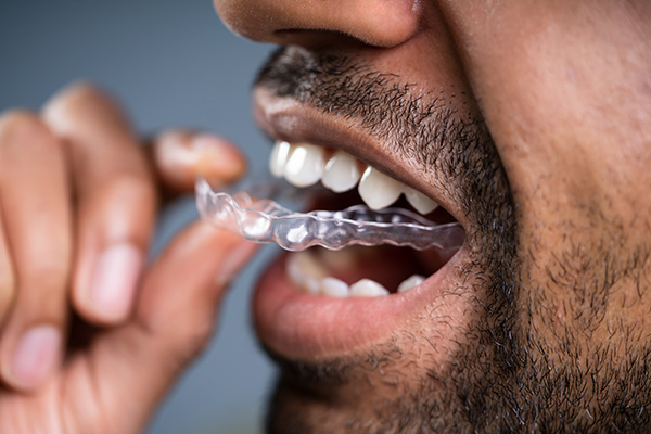 A Cosmetic Dentist Explains Benefits of Clear Aligners from Allure Dental in Chicago, IL