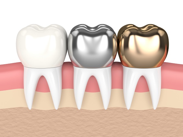 Do Dental Crowns Look Natural?