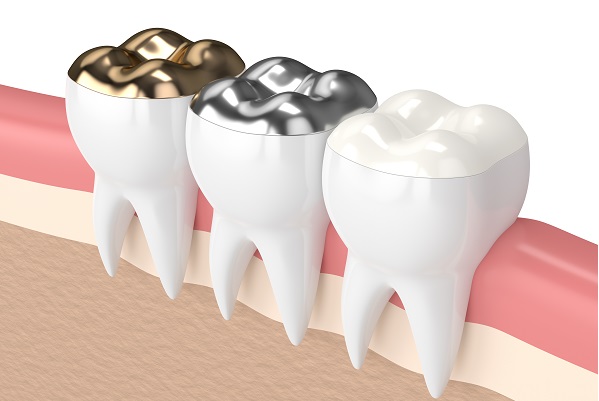When Is A Dental Filling Necessary?