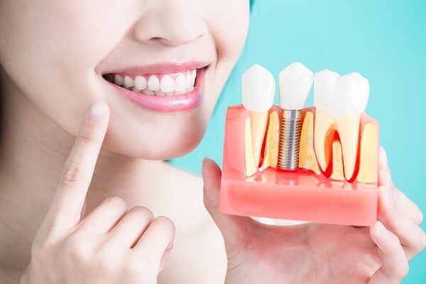 How Dental Implants Compare To Natural Teeth