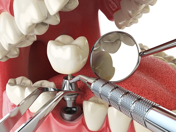 Can A Dental Implant Be Replaced?