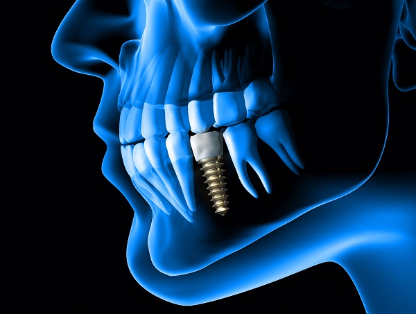 dental implants Chicago, IL