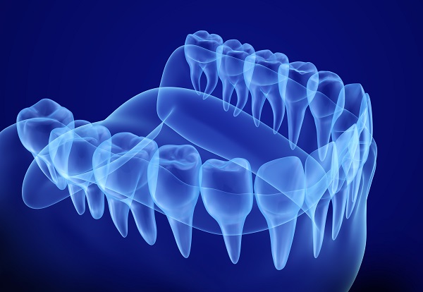 How Implant Supported Dentures Can Stop Bone Loss