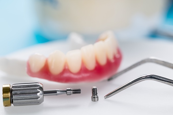 Overdentures Supported By Dental Implants