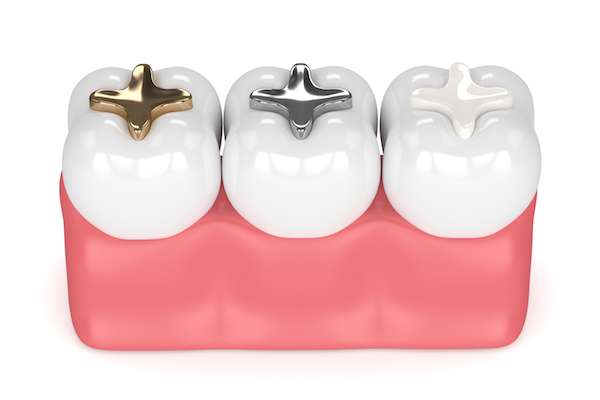A General Dentist Discusses Different Filling Options from Allure Dental in Chicago, IL