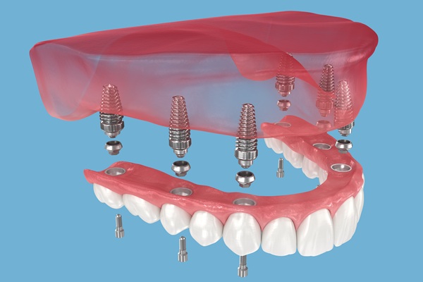 Caring For The Gums Under Implant Supported Dentures