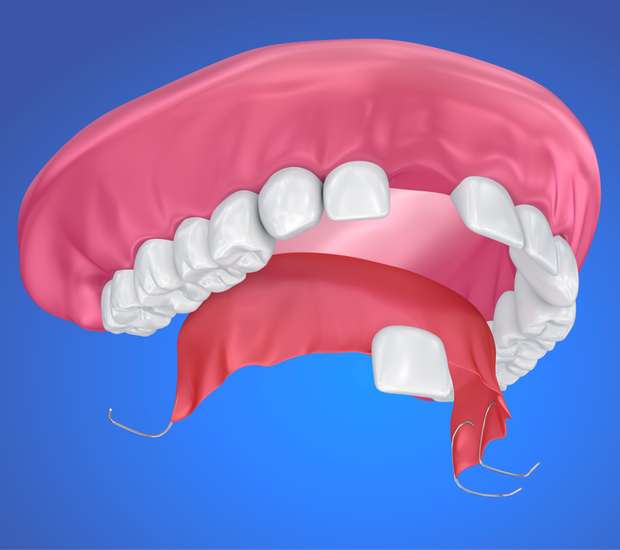 Chicago Partial Denture for One Missing Tooth