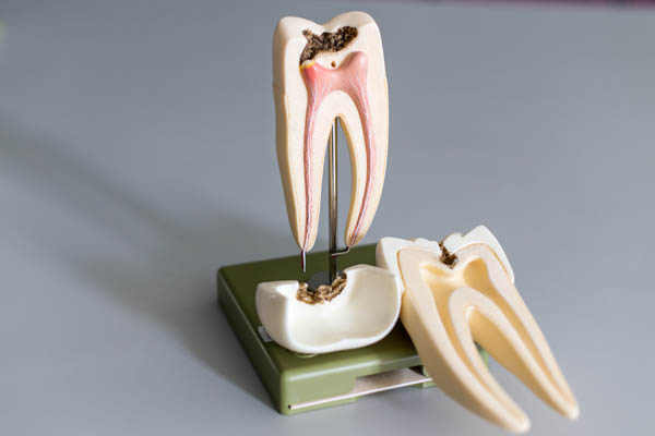 The Risks Of Delaying Root Canal Therapy