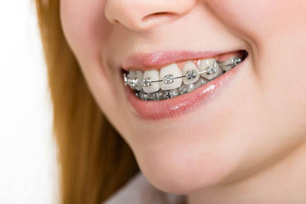 Traditional Braces Versus Clear Aligner Options