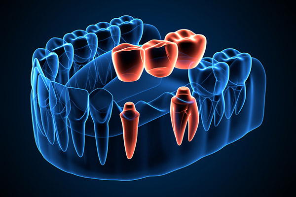 Traditional Bridges Are An Option For Replacing Missing Teeth