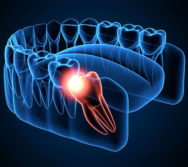 Chicago Wisdom Teeth Extraction